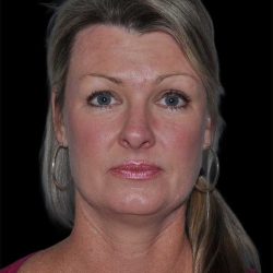 All Me Facelift Before & After Patient #252