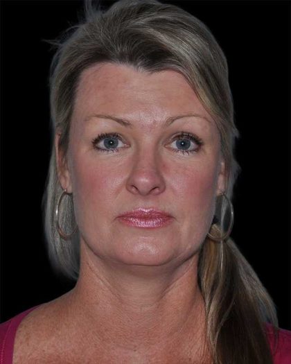 All Me Facelift Before & After Patient #252