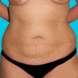 Abdominoplasty (Tummy Tuck) Before & After Patient #1488