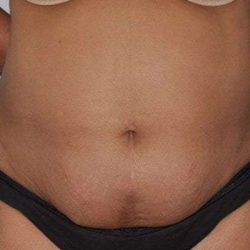 Abdominoplasty (Tummy Tuck) Before & After Patient #1495