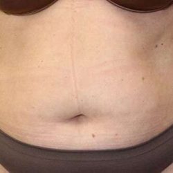 Abdominoplasty (Tummy Tuck) Before & After Patient #1523