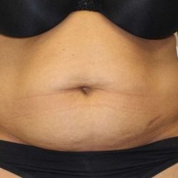 Abdominoplasty (Tummy Tuck) Before & After Patient #1530