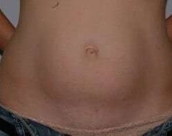Abdominoplasty (Tummy Tuck) Before & After Patient #1537