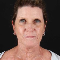 All Me Facelift Before & After Patient #461