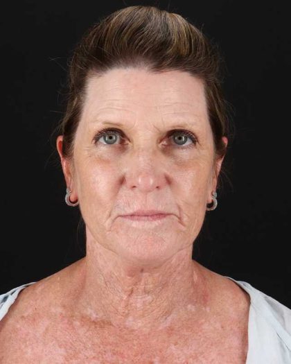 All Me Facelift Before & After Patient #461