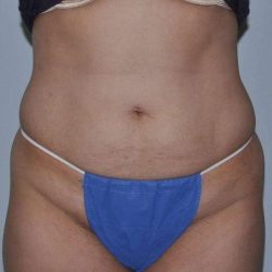 Abdominoplasty (Tummy Tuck) Before & After Patient #1556