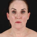 All Me Facelift Before & After Patient #472