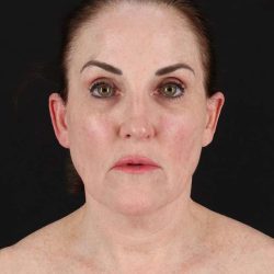 All Me Facelift Before & After Patient #472