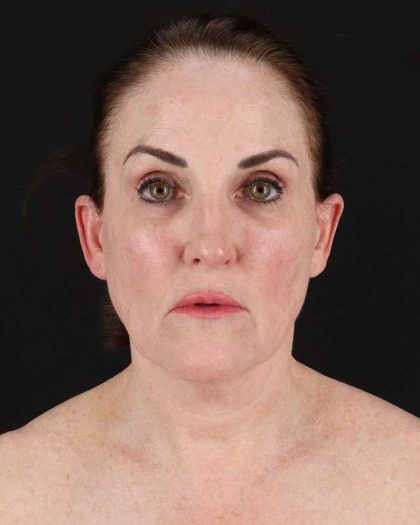 All Me Facelift Before & After Patient #472