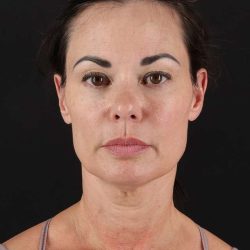 All Me Facelift Before & After Patient #483
