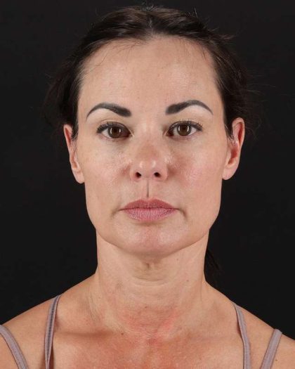All Me Facelift Before & After Patient #483