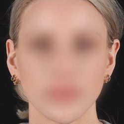 Otoplasty Before & After Patient #513