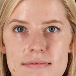 Rhinoplasty Before & After Patient #524