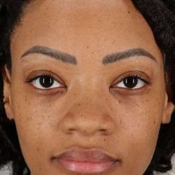 Rhinoplasty Before & After Patient #535