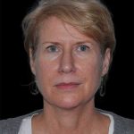 All Me Facelift Before & After Patient #263