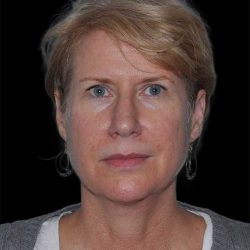 All Me Facelift Before & After Patient #263