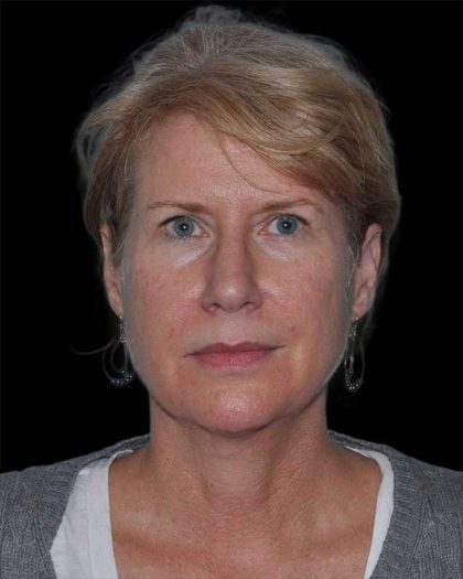All Me Facelift Before & After Patient #263