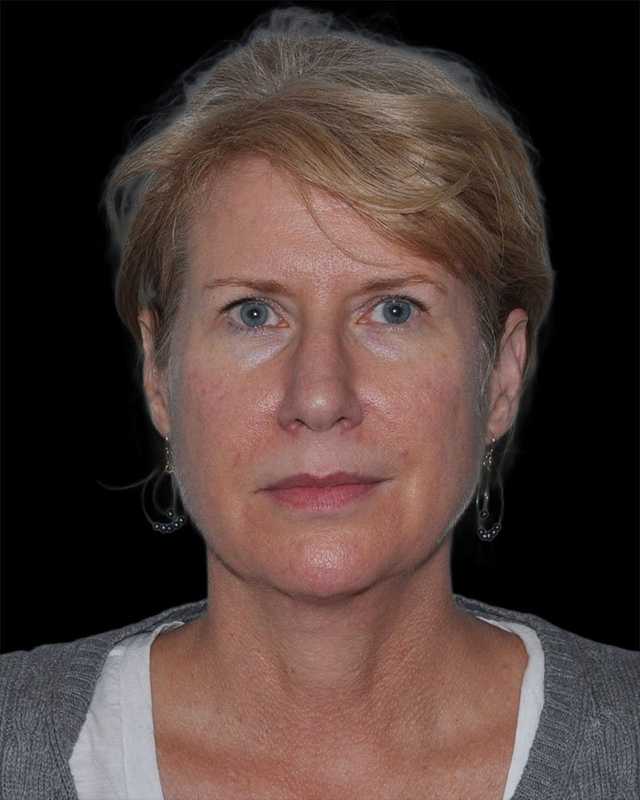 All Me Facelift Before & After Patient #263