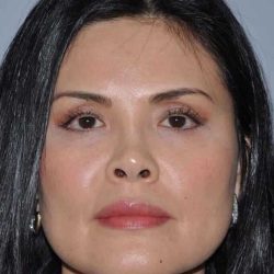 Rhinoplasty Before & After Patient #553