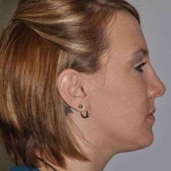 Rhinoplasty Before & After Patient #567