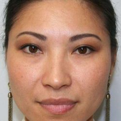 Rhinoplasty Before & After Patient #574
