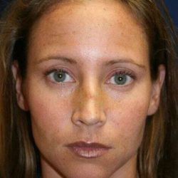 Rhinoplasty Before & After Patient #588