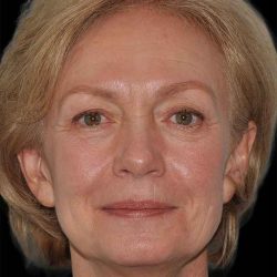 All Me Facelift Before & After Patient #274