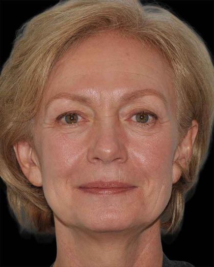 All Me Facelift Before & After Patient #274