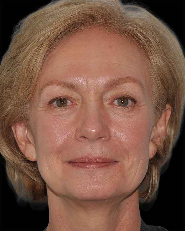 All Me Facelift Before & After Patient #274