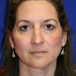 Rhinoplasty Before & After Patient #621