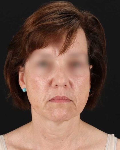 All Me Facelift Before & After Patient #229