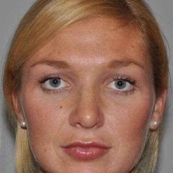Rhinoplasty Before & After Patient #633