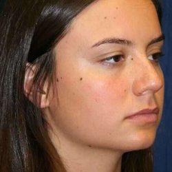 Rhinoplasty Before & After Patient #638