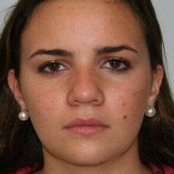 Rhinoplasty Before & After Patient #645