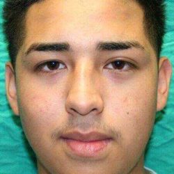 Rhinoplasty Before & After Patient #652