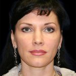 All Me Facelift Before & After Patient #286