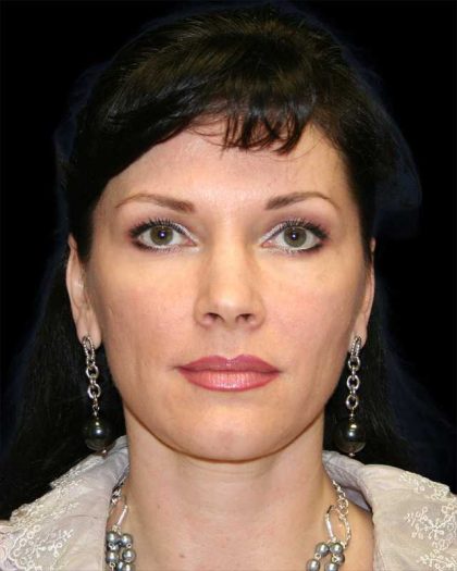 All Me Facelift Before & After Patient #286