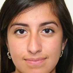 Rhinoplasty Before & After Patient #678