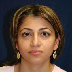 Rhinoplasty Before & After Patient #699