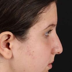 Rhinoplasty Before & After Patient #702