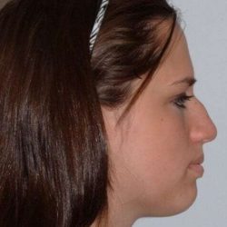 Rhinoplasty Before & After Patient #708