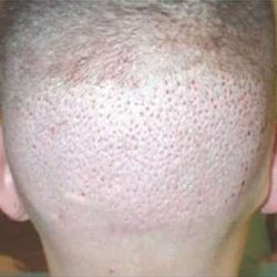 Hair Restoration Before & After Patient #711