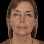 All Me Facelift Before & After Patient #297