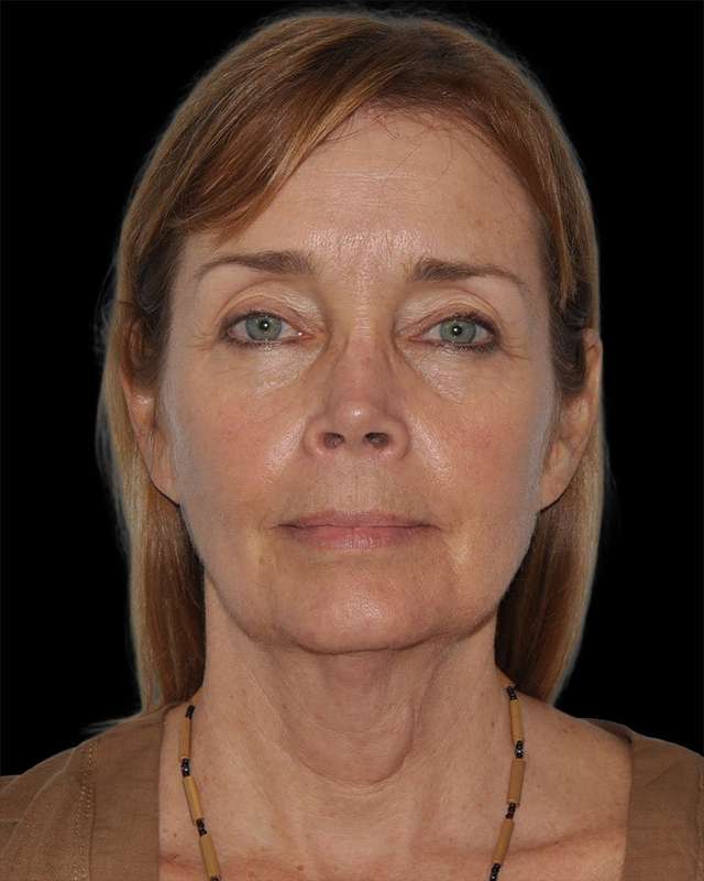 All Me Facelift Before & After Patient #297