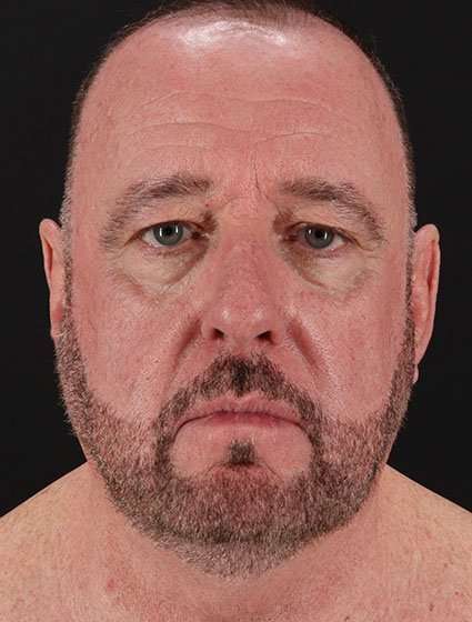 All Me Facelift Before & After Patient #728