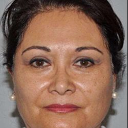 All Me Facelift Before & After Patient #749