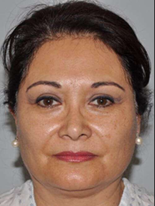 All Me Facelift Before & After Patient #749