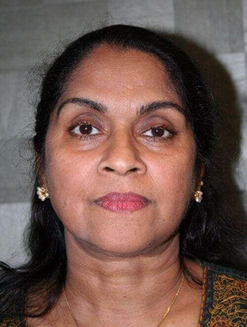 All Me Facelift Before & After Patient #756