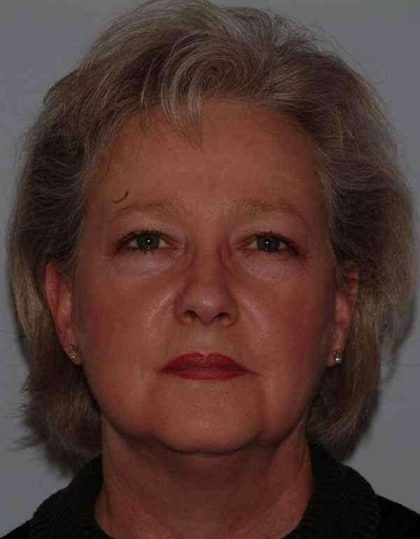 All Me Facelift Before & After Patient #763
