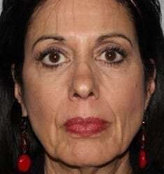 All Me Facelift Before & After Patient #770